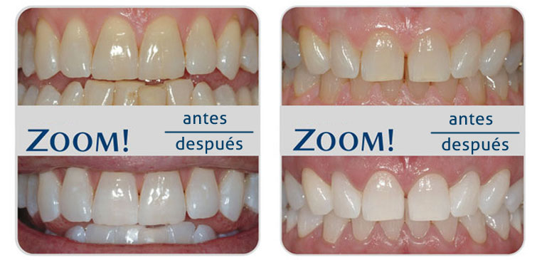 Microcirugía periodontal en Gijon